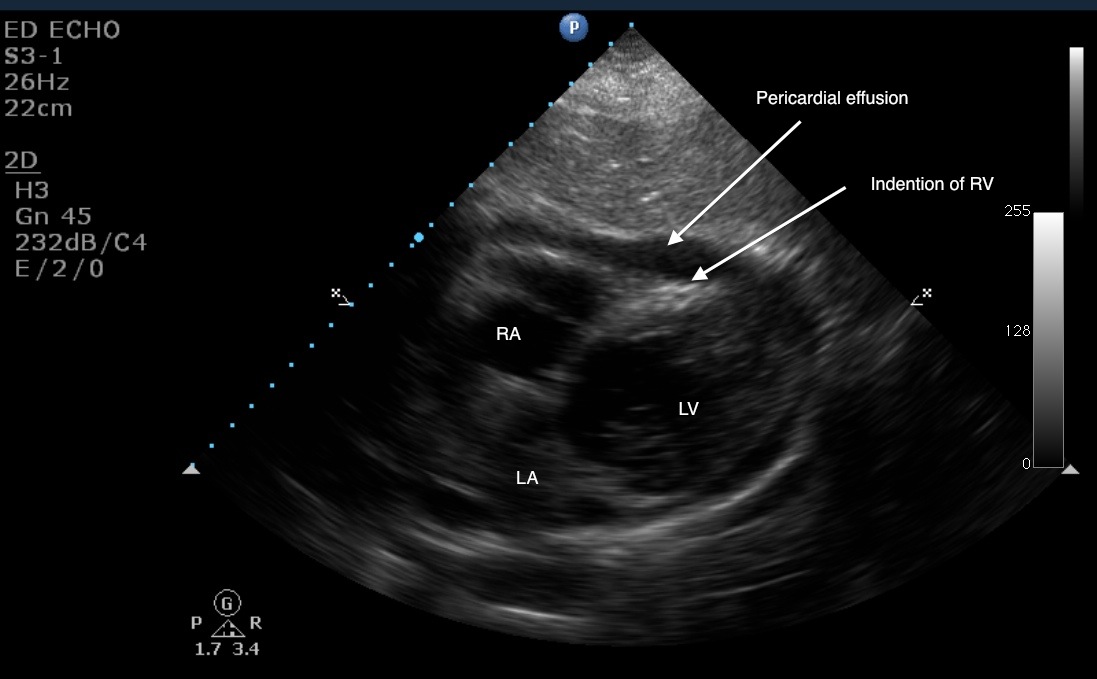 Emory Emergency Ultrasound Pericardial Effusion Tamponade emory-emergency-ultrasound-pericardial-effusion-tamponade