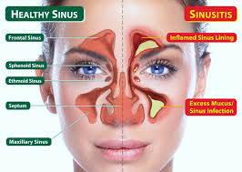obat sinusitis alami