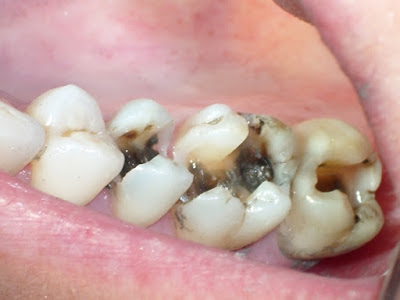 Tẩy trắng cho răng sâu bị đen bằng Laser được không? 
