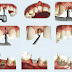 Cấy ghép răng Implant là gì?