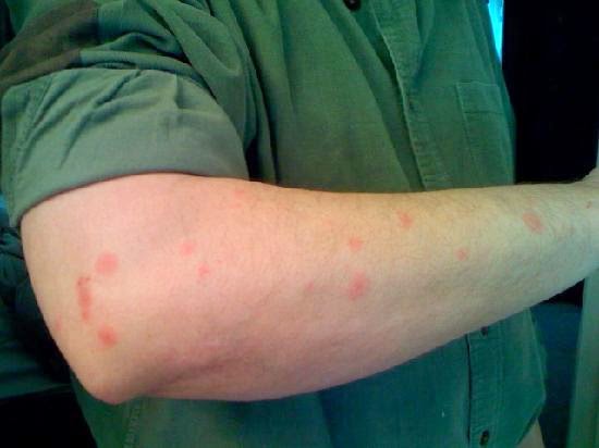 About Bed Bugs Bed Bug Bite Pics About Bed Bugs Bed Bug Bite Pics