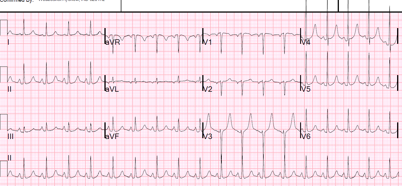 Dr. Smith's ECG Blog Potassium and Magnesium how low is too low?