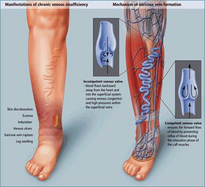 prevenirea dezvoltarii varicoase systemic veins carry and systemic arteries carry
