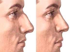 NARIZ DE HOMBRE ANTES Y DESPUES Nariz de un hombre antes y después