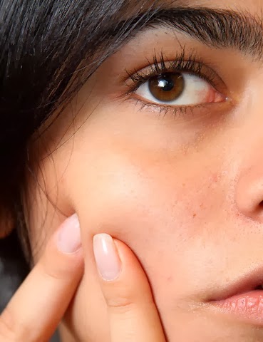 acne skin disease Tips