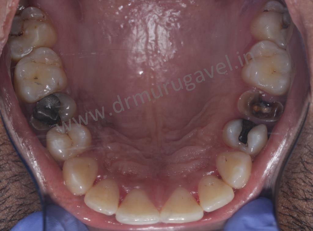 Severe decayed tooth extraction and immediate dental implants in chennai