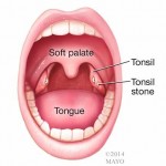 What Are Tonsil Stones? - Tonsil Stones