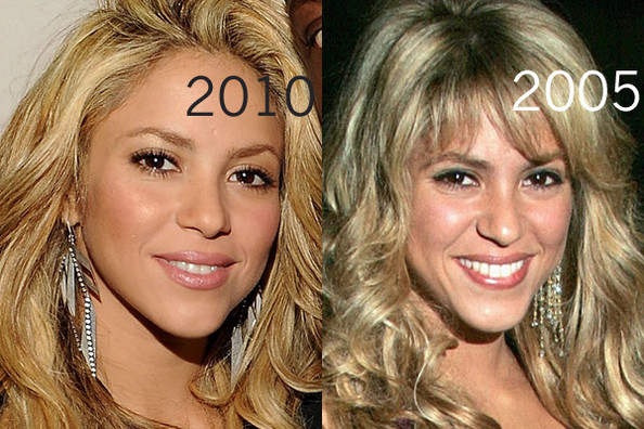 mca dies: Shakira Plastic Surgery