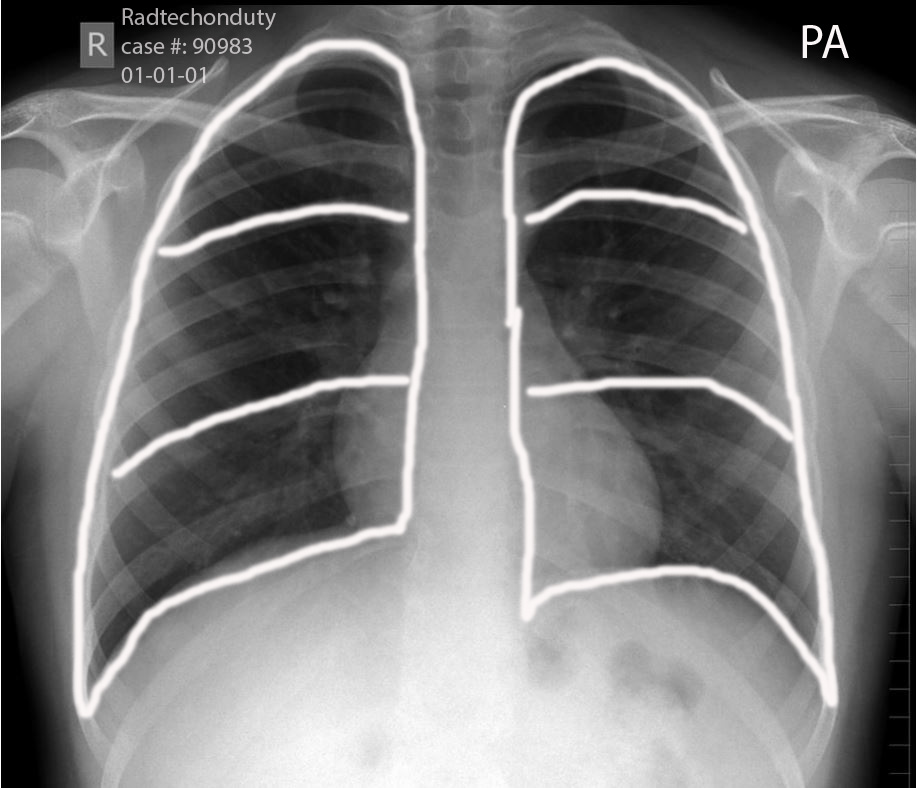 heart Heart Failure Chest X Ray Abcde