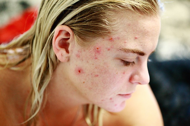 Acne Skin