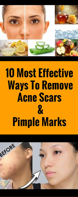 10 MOST EFFECTIVE WAYS TO REMOVE ACNE SCARS & PIMPLE MARKS