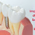 Implanturile dentare: beneficii și prețuri