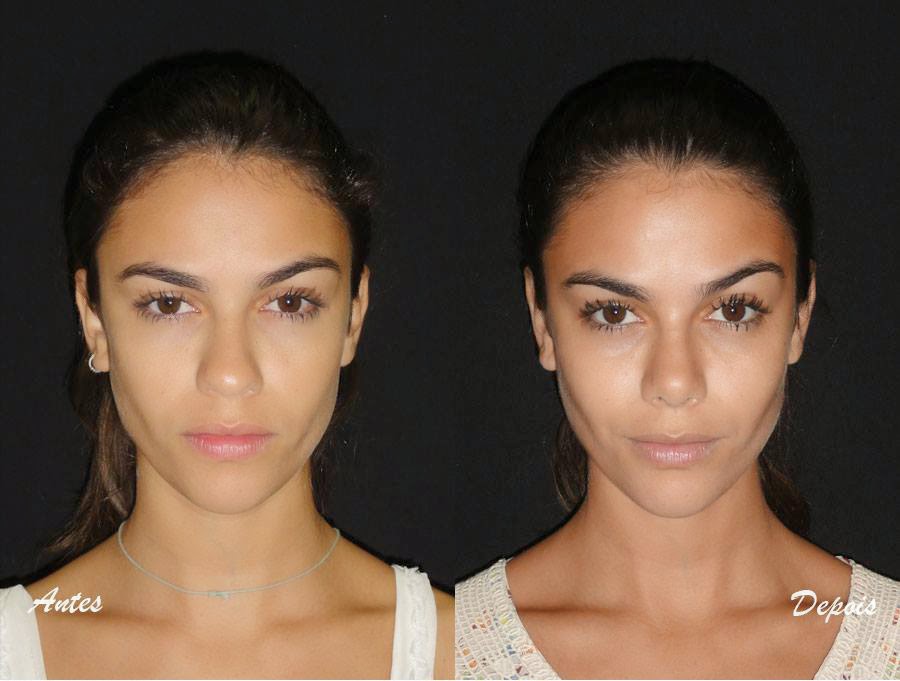 Rinoplastia Antes e Depois: Fotos Antes e Depois da Rinoplastia