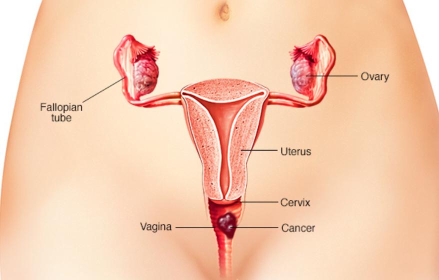 Cervical Cancer Survival Rates By Age
