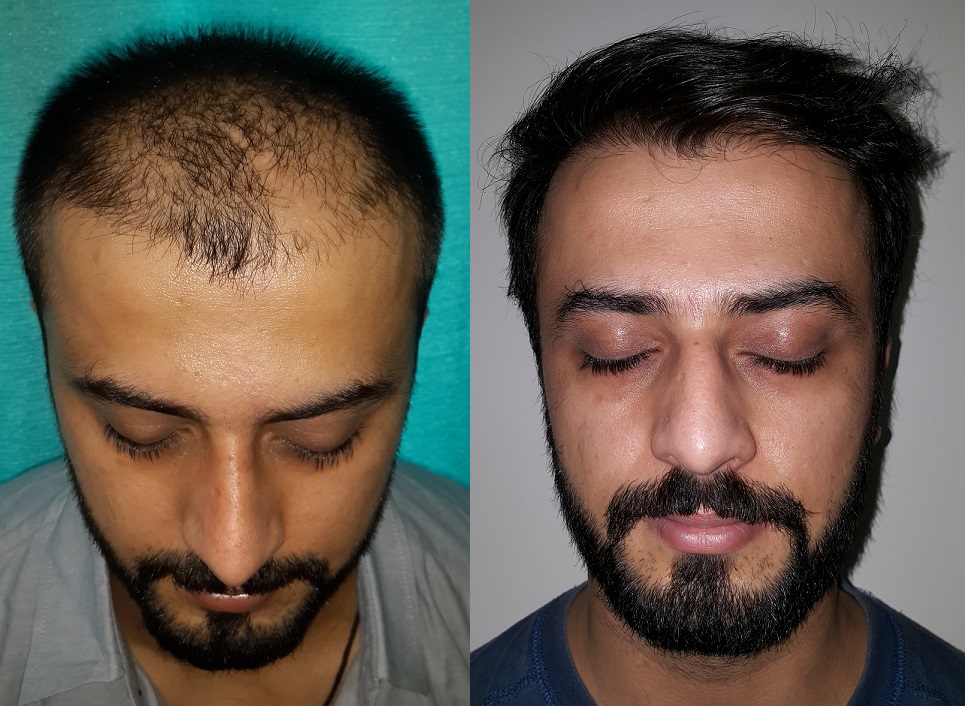 Lahore Hair Transplant: Before after pictures of our hair transplant  Patients