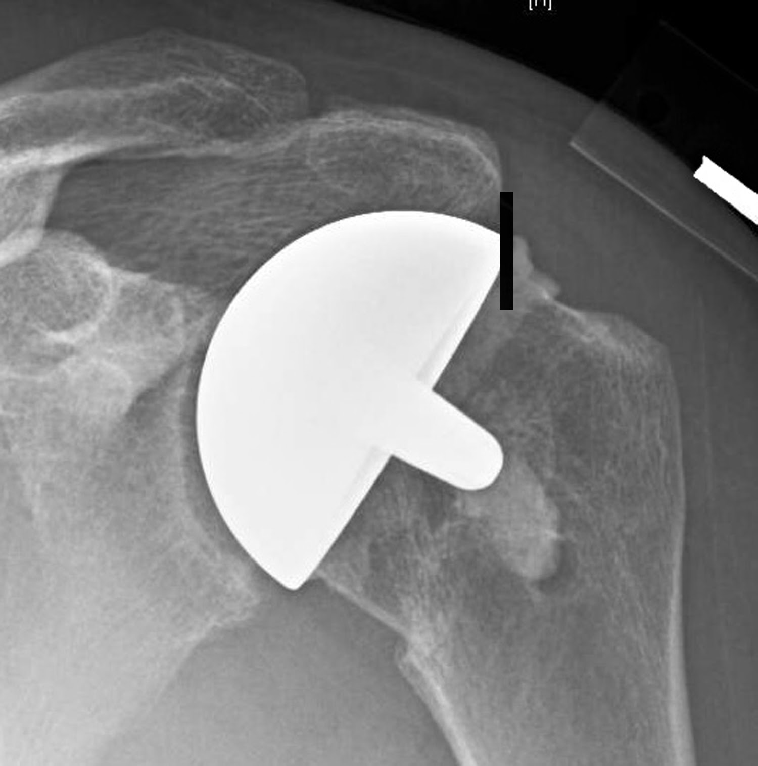 UW Shoulder and Elbow Academy Shoulder joint replacement selecting