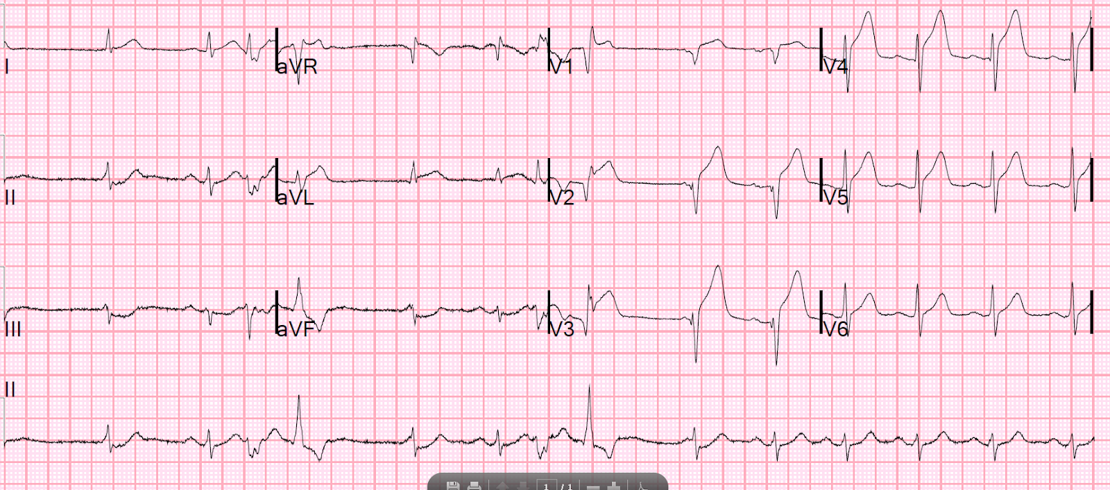Dr. Smith's ECG Blog Anterior STEMI and multiform PVCs with Narrow