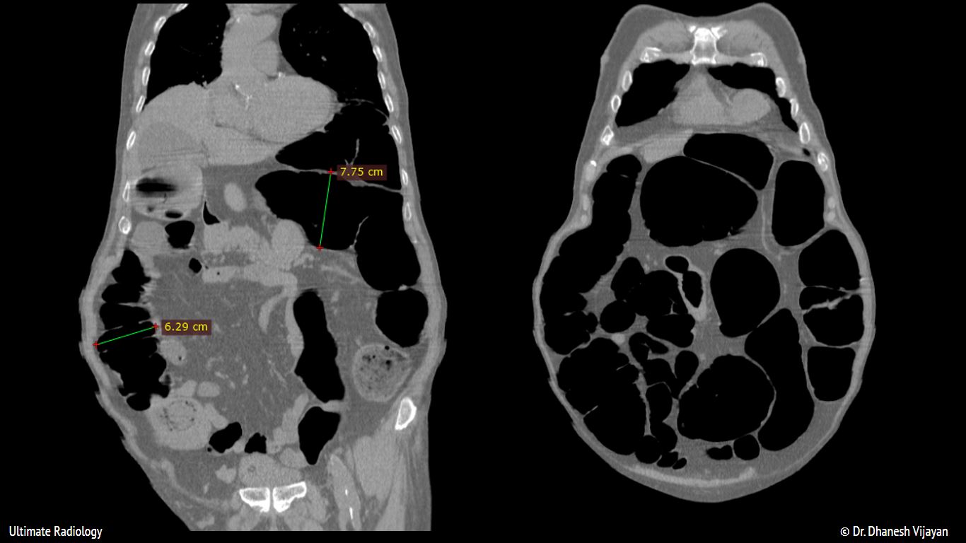 Ultimate Radiology Ogilvie Syndrome or Acute Colonic Pseudo Obstruction