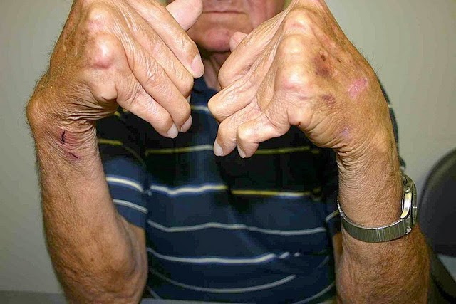 Photograph of male rheumatoid arthritis sufferer