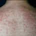 Cara Cepat Menyembuhkan Penyakit Herpes Di Permukaan Punggung