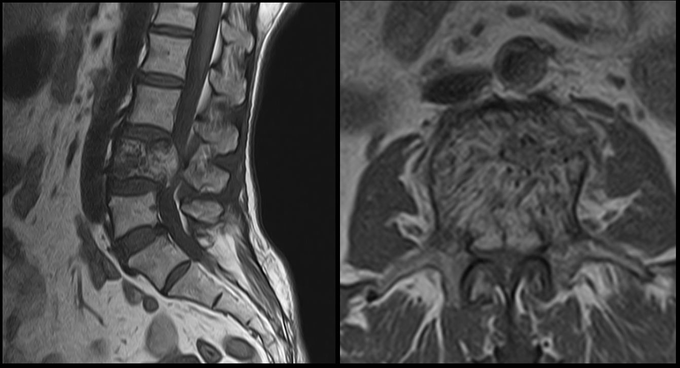 Ultimate Radiology Aggressive ('Malignant') Hemangioma of Vertebrae