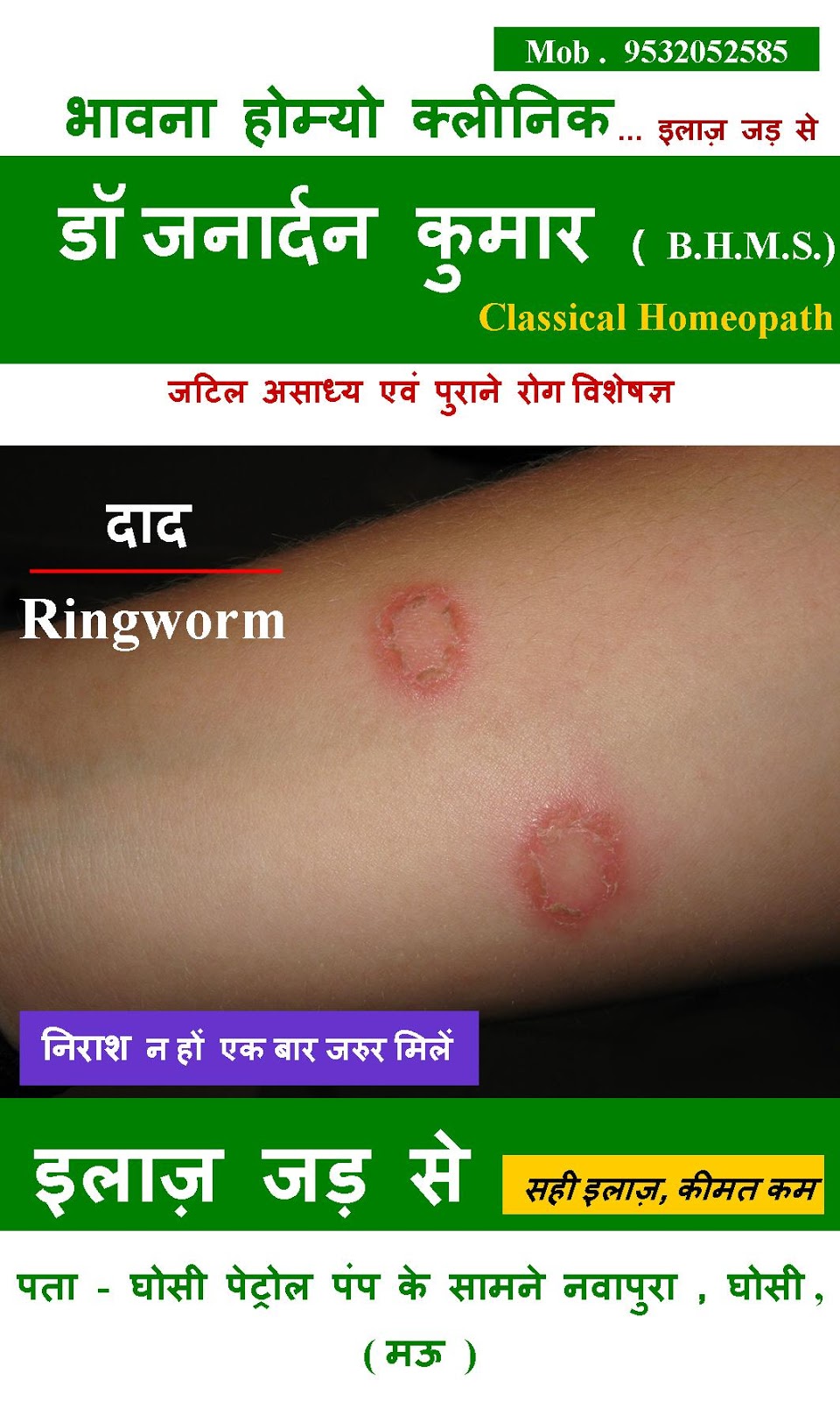 Homeopathic Treatment for Ringworm Bhavana Homeo Clinic Bhavana