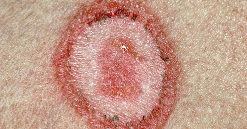 Psoriasis or ringworm?<a name='more'></a> Symptoms, treatment, and other rashes