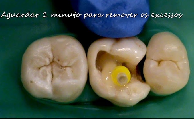 DENTÍSTICA: Restauração em dente Posterior com pino de Fibra de vidro