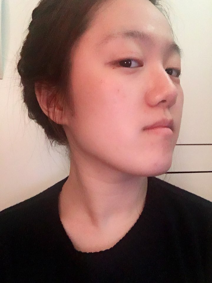 Real Patient Review Double Jaw Surgery + Rhinoplasty at DA