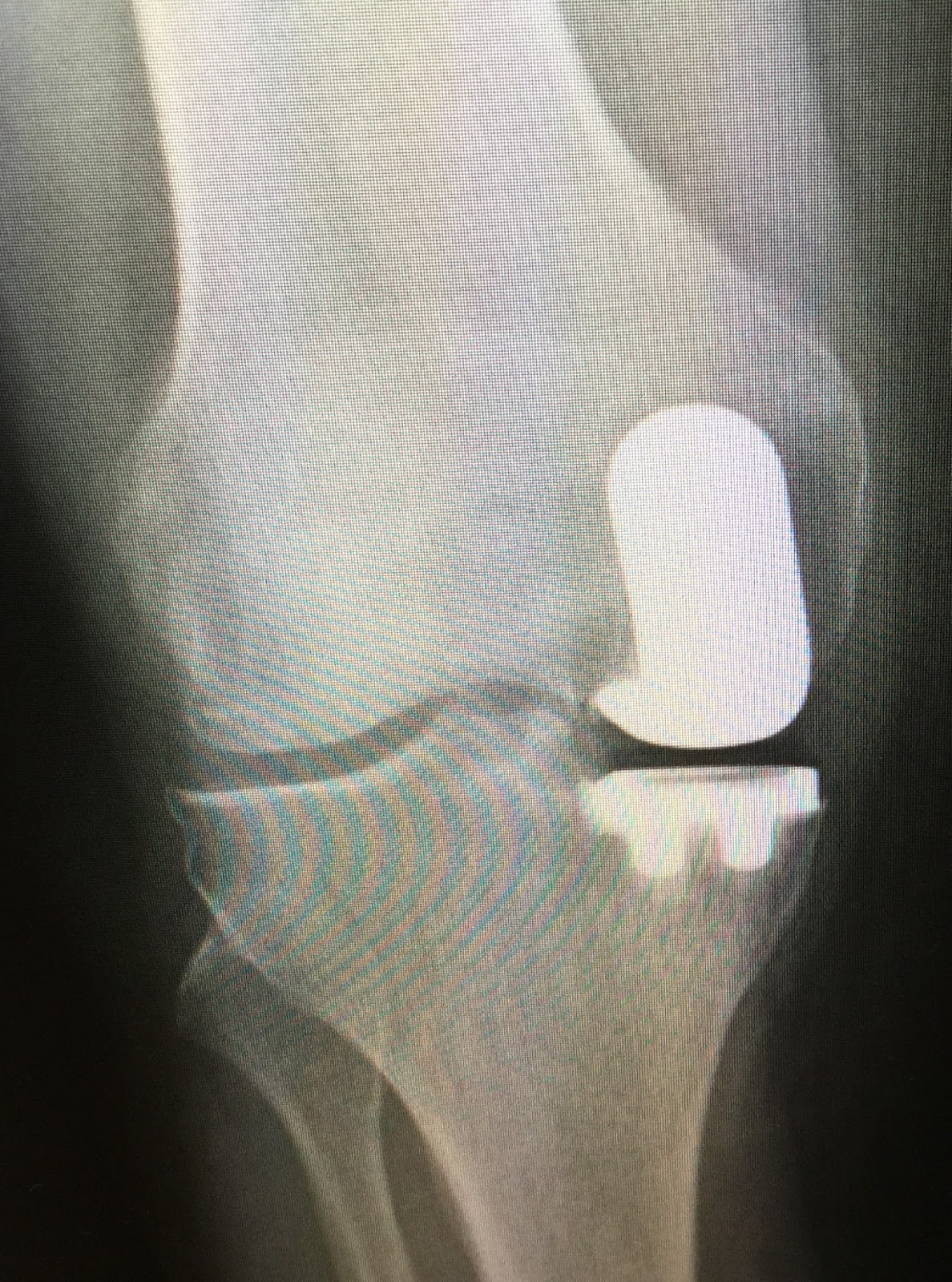 Knee Replacement Advanced Knee Care