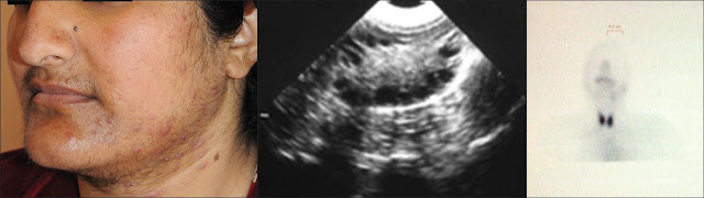 Polycystic Ovairian Disease