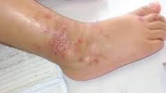 Obat kulit gatal eksim pada kaki dan betis