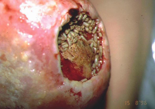 Gas gangrene: MedlinePlus Medical Encyclopedia