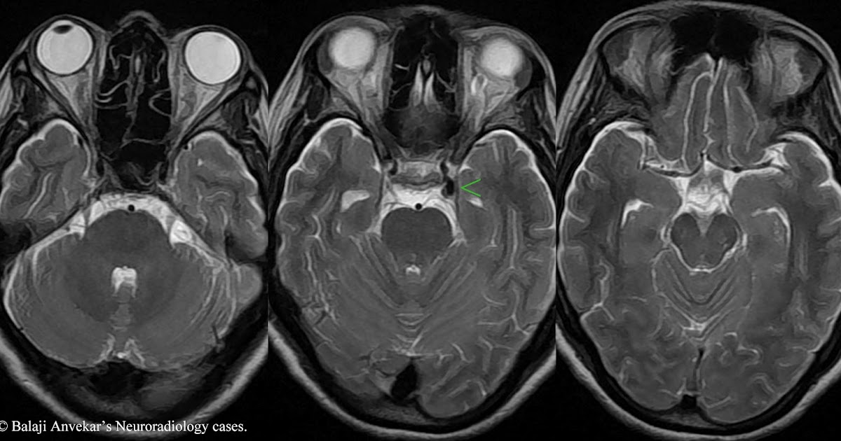 neuroradiology-cases-aneurysmal-3rd-cn-palsy