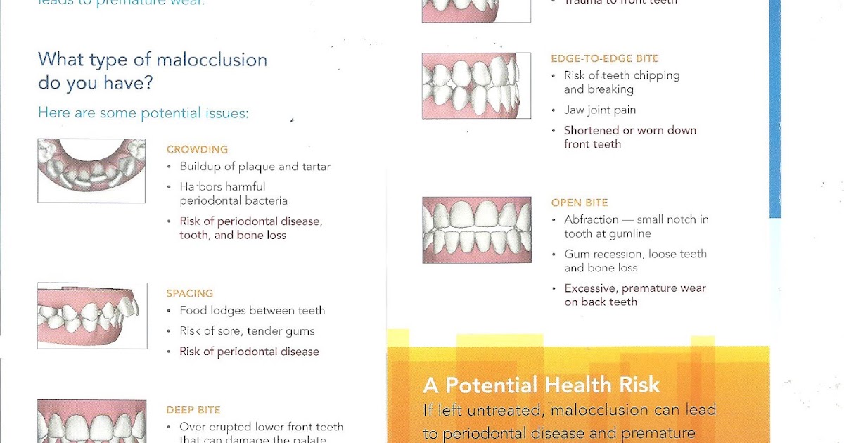 TORREY PINES ORTHODONTICS BLOGDr. Mary Lynn Merz Malocclusion and