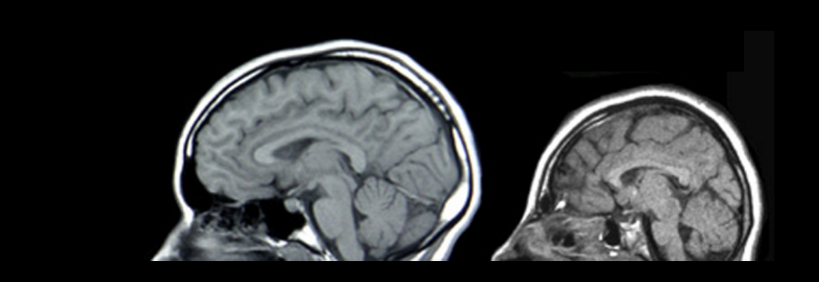 Диффузный характер головного мозга. Синдром Эдвардса микроцефалия. Мозг при умственной отсталости. Мозг умственно отсталого.