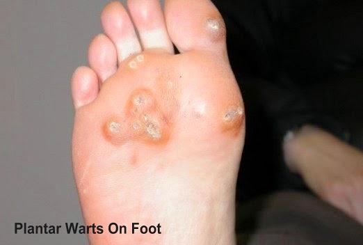 Plantar Warts On Foot