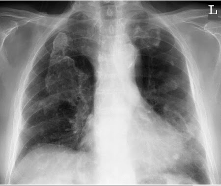 ON - RADIOLOGY: Asbestos related pleural plaques lymphoma cancer diagrams 