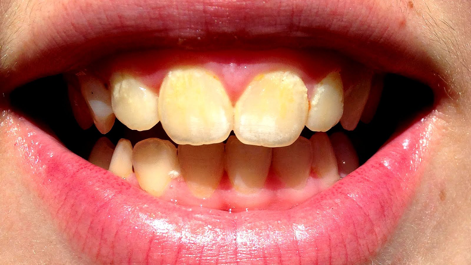 How To Whiten Very Yellow Teeth Yellow Choices