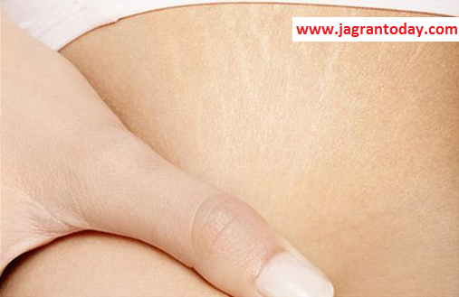 Home Remedies to Remove Stretch Marks