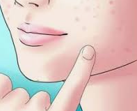 Jerawat B Inggrisnya Jerawat Pengertian Jerawat Solusi Jerawat