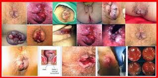 Foto OBAT BAB BERDARAH APA YANG ALAMI