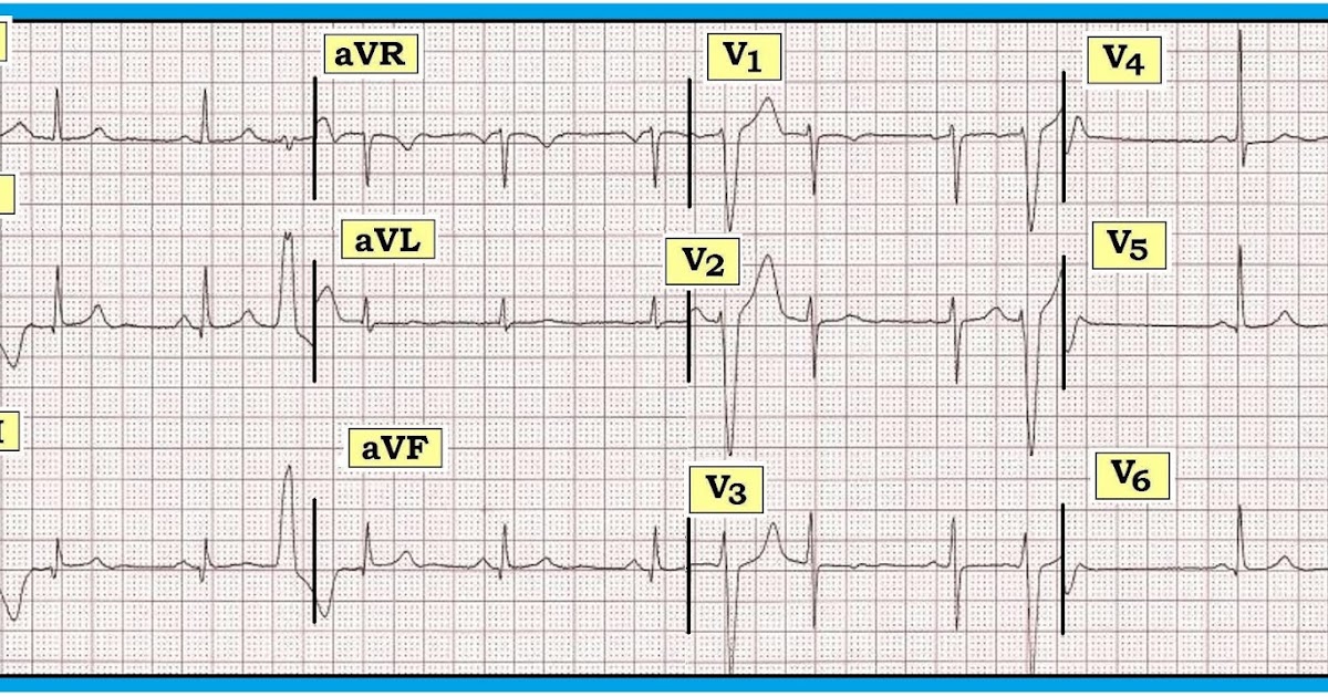 How To Diagnose Pvcs On Ecg at Kate Wardill blog