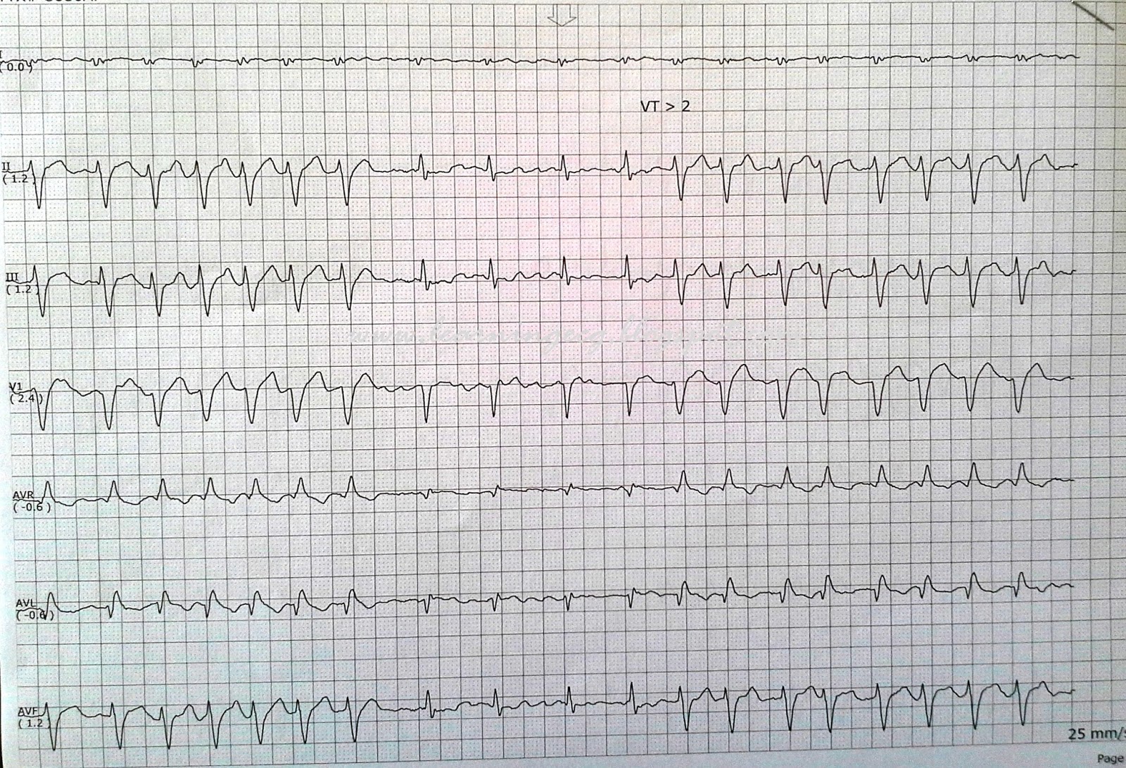 ECG Rhythms Acceleration dependent Aberrancy ecg-rhythms-acceleration-dependent-aberrancy