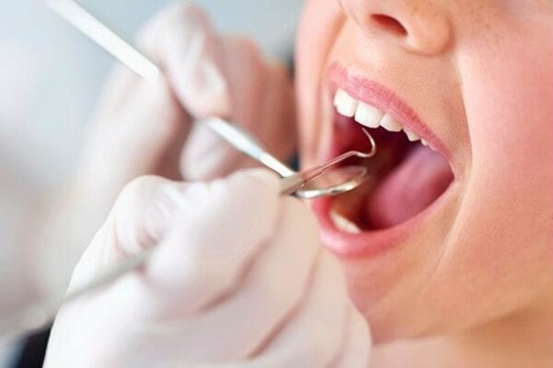 Tự lấy cao răng tại nhà bằng nguyên liệu tư nhiên Tự lấy cao răng tại nhà bằng nguyên liệu tư nhiên