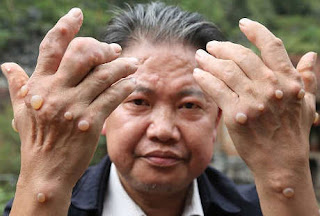 Mencari Obat Salep Kutil Kelamin yang di Apotik, Beli Obat Herbal untuk Wasir Ambeyen Berdarah, Beli Obat Wasir Terdaftar yang di BPOM
