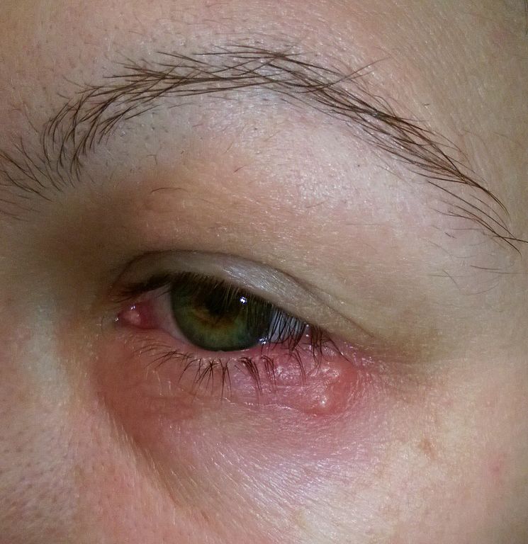 Timmy Chin Treatment For Herpes Eye Infection Genital Warts Therapy