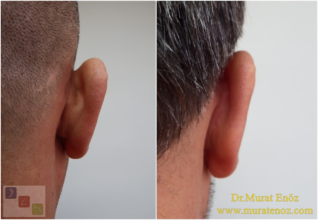 Before and After Photos for Ear Plastic Surgery in Istanbul, Turkey - Ear Plastic Surgery - Protruding Ear Surgery in Istanbul - Modified Technique - Conchomastoid Technique - Otoplasty Operation in Istanbul - Otoplasty Operation in Turkey