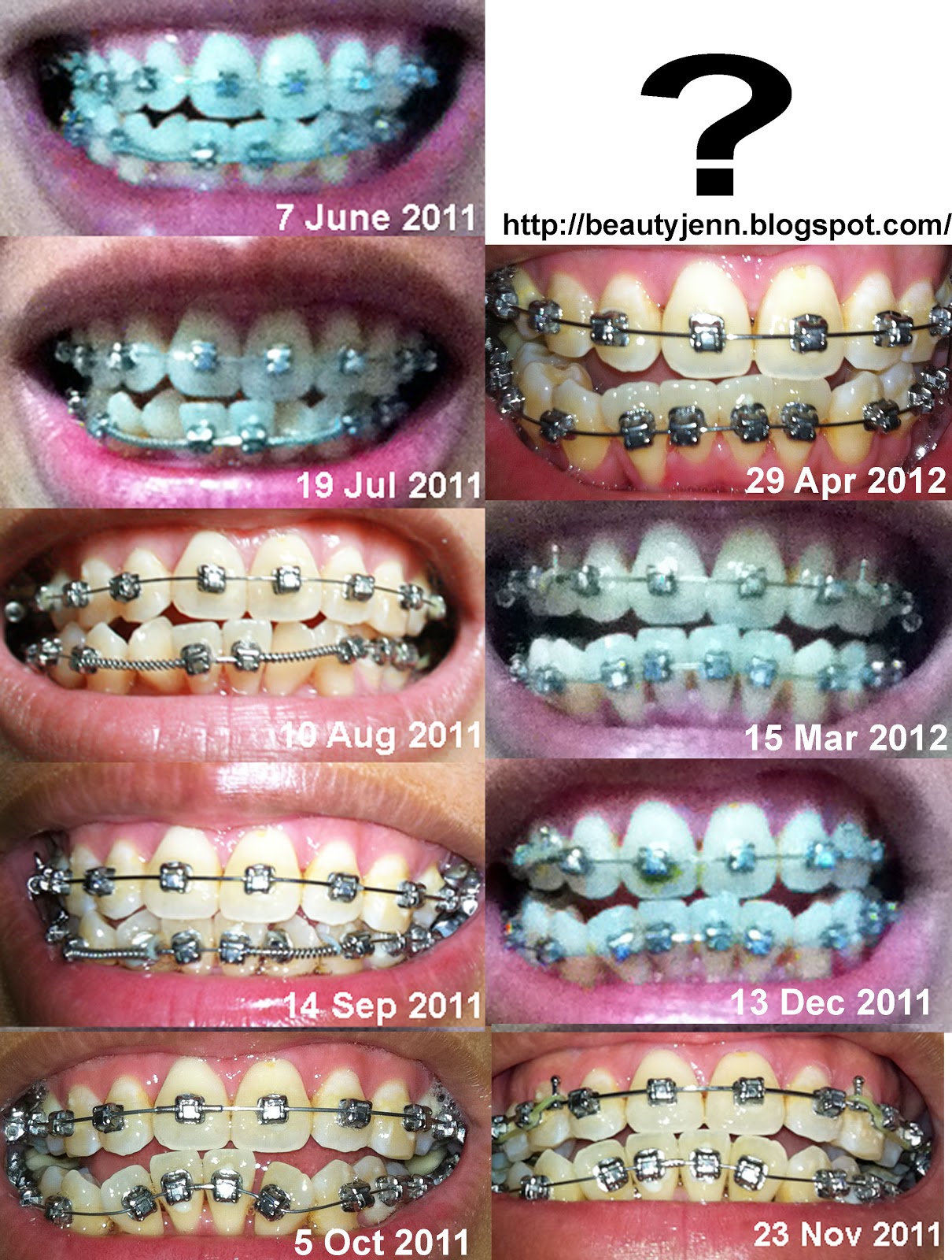 My Life's Inspirations! Damon 3 Braces Update A year after starting on the system
