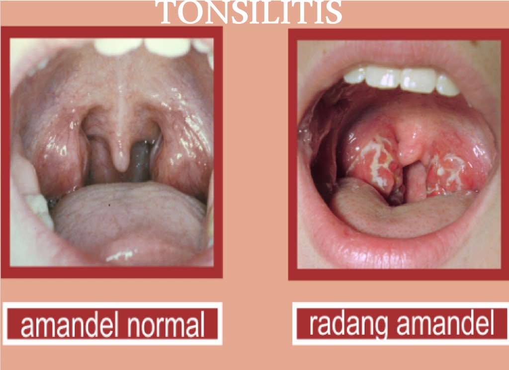 Cara Mengatasi Penyakit Amandel (Tonsilitis)